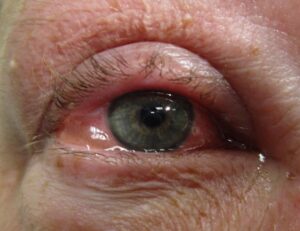 Allergic conjunctivitis