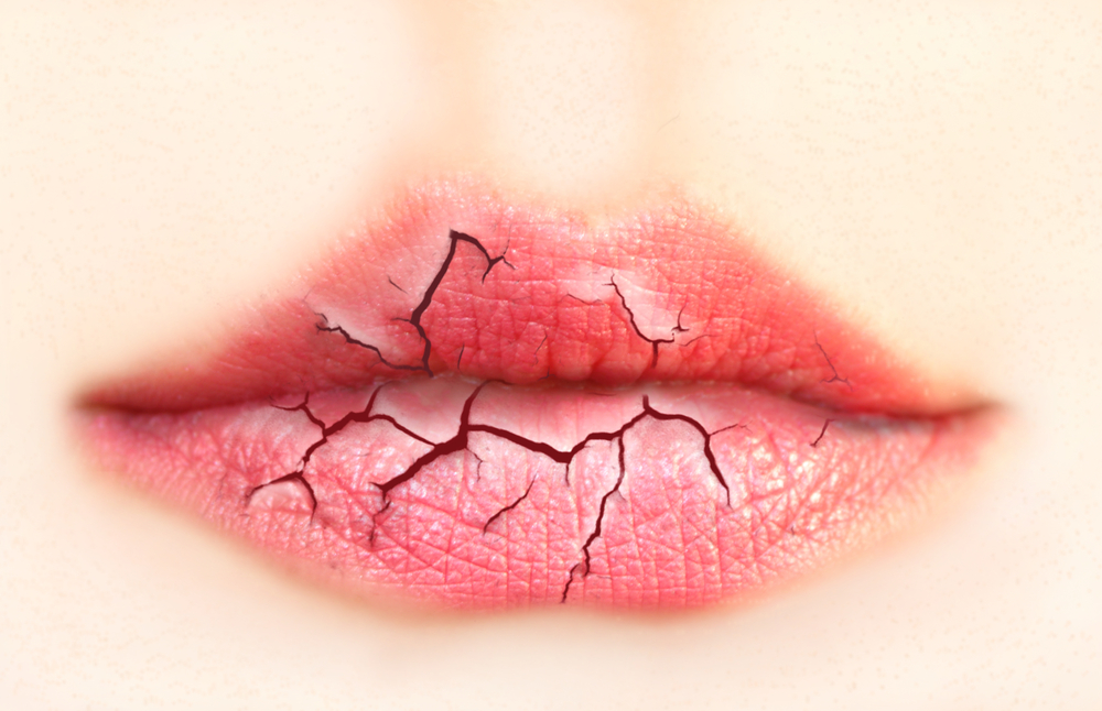 Cracked and dry lips