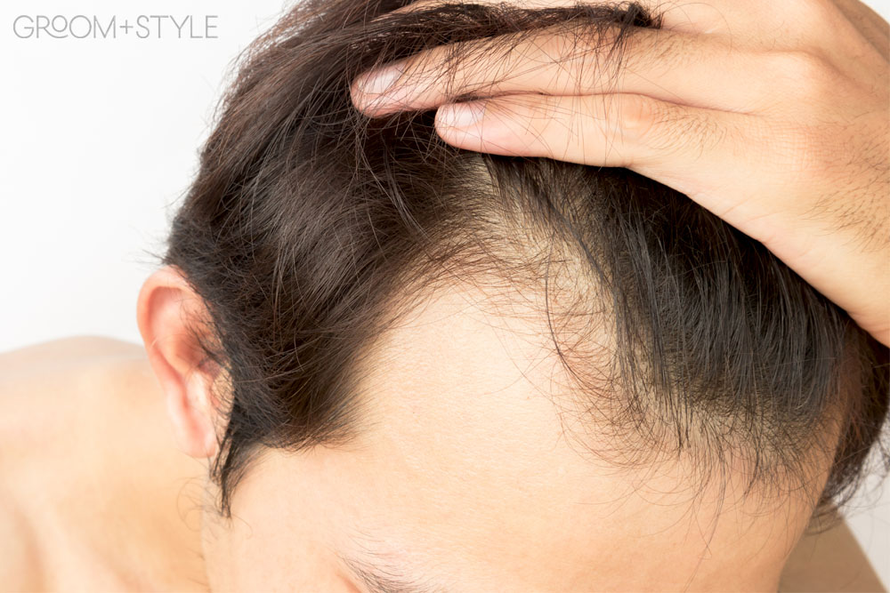 iRestore VS Capillus hair loss