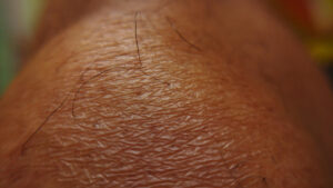 Ingrown Hair