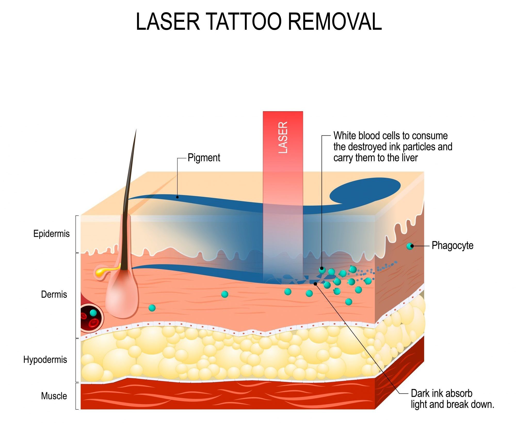 tattoo removal