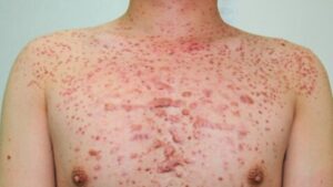 Malassezia (Pityrosporum) folliculitis