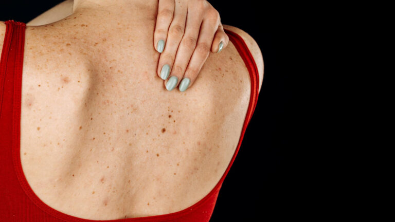 How to get rid of back acne